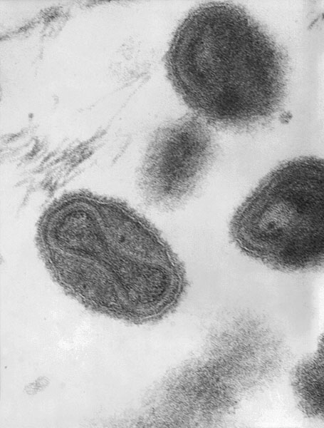 Smallpox virus epidemic